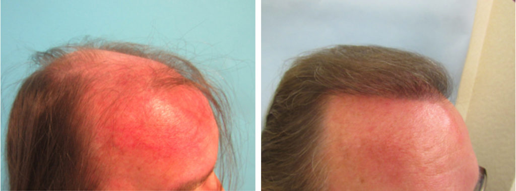 EDWARD D, 2033 GRAFTS Age 59 | Center For Hair Transplantation EDWARD D, 2033 GRAFTS Age 59 | Center For Hair Transplantation